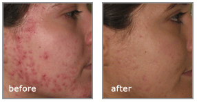 acne behandeling laser