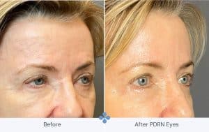 Before-After PDRN eyes